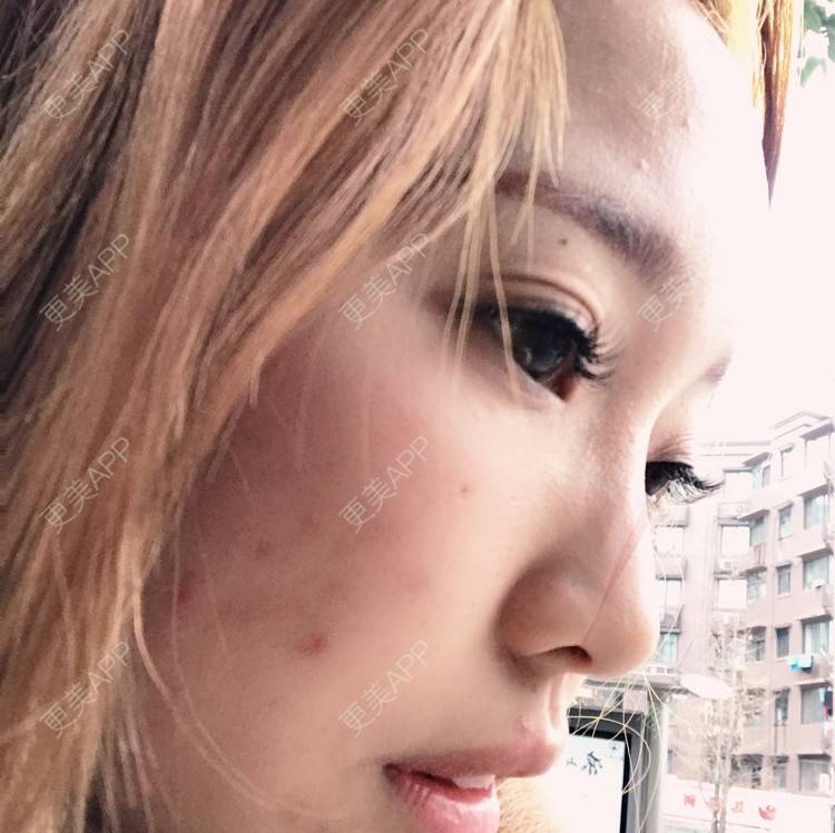 更美 - Qi7CHEN的祛眼袋经验 | 祛眼袋 | 成都