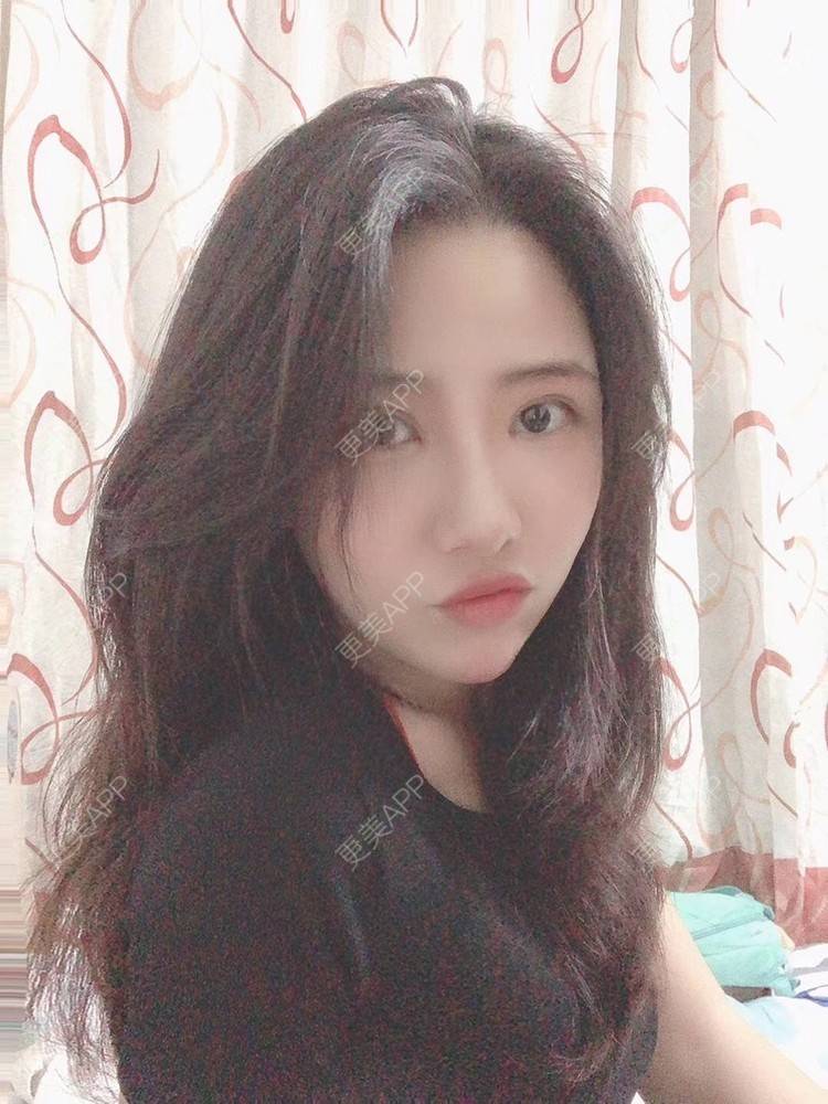 更美 - 更美用户R2vuT1w108的双眼皮修复经验 | 广州 | 双眼皮修复