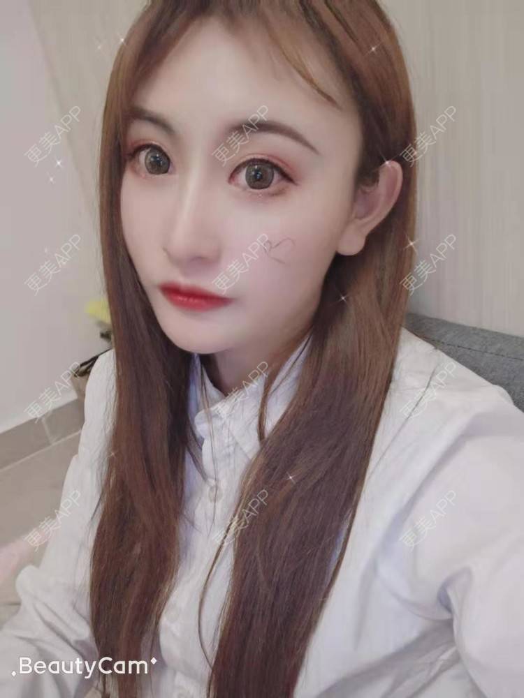 更美 - 更美用户U6Pt7ApV7A的吸脂瘦脸经验 | 吸脂瘦脸 | 重庆