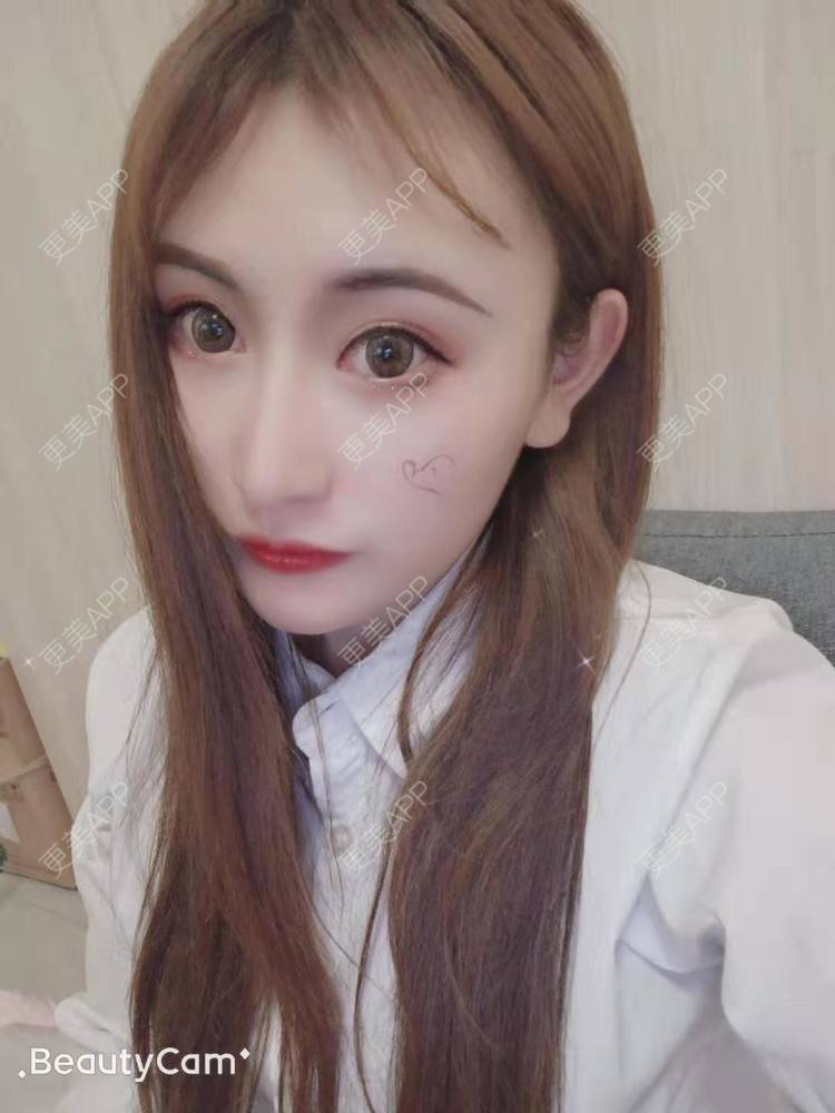 更美 - 更美用户U6Pt7ApV7A的吸脂瘦脸经验 | 吸脂瘦脸 | 重庆