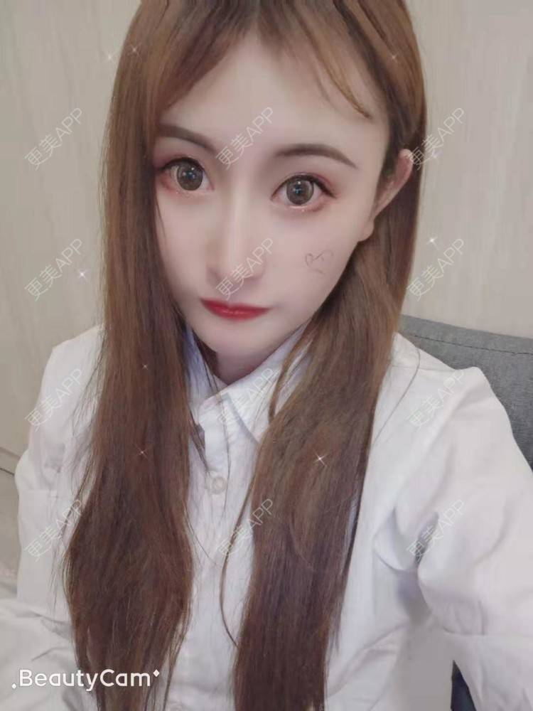 更美 - 更美用户U6Pt7ApV7A的吸脂瘦脸经验 | 吸脂瘦脸 | 重庆