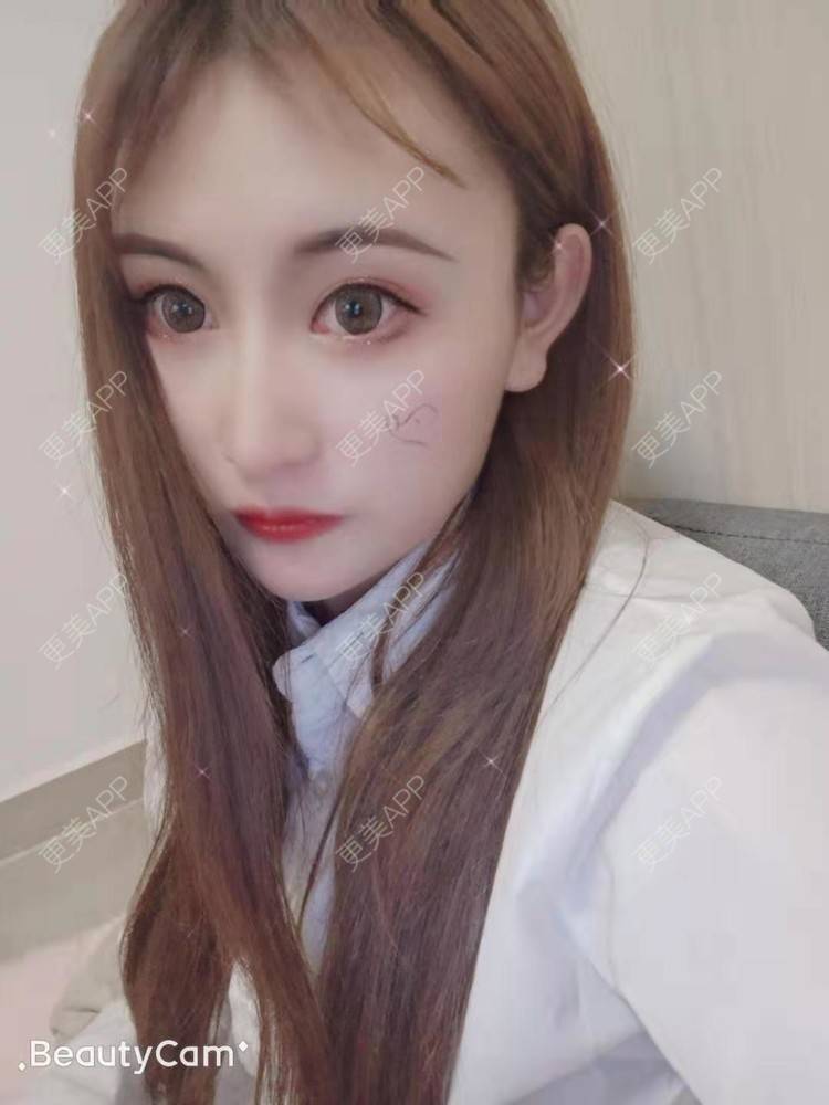更美 - 更美用户U6Pt7ApV7A的吸脂瘦脸经验 | 吸脂瘦脸 | 重庆