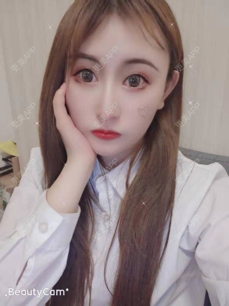 更美 - 更美用户U6Pt7ApV7A的吸脂瘦脸经验 | 吸脂瘦脸 | 重庆