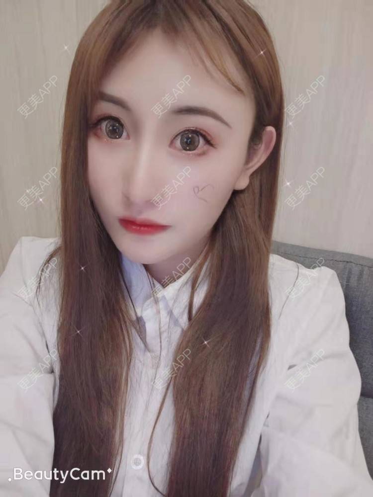 更美 - 更美用户U6Pt7ApV7A的吸脂瘦脸经验 | 吸脂瘦脸 | 重庆