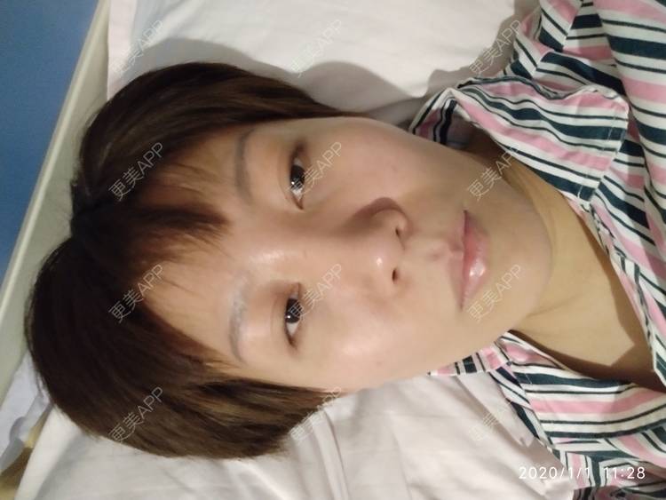 更美 - 更美用户WFzD4DOKgO的自体脂肪填充泪沟经验 | 自体脂肪填充泪沟 | 自体脂肪丰苹果肌 | 自体脂肪垫下巴 | 自体脂肪丰太阳穴 | 吸脂 | 成都