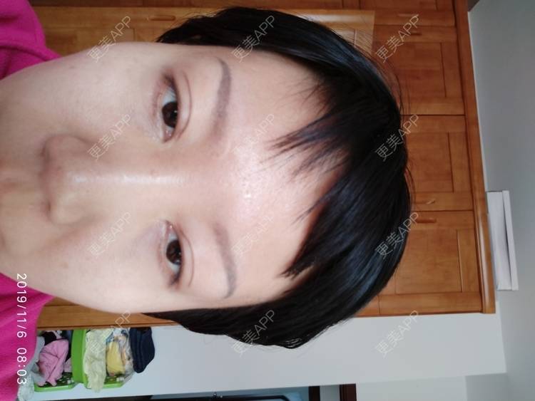 更美 - 更美用户WFzD4DOKgO的自体脂肪填充泪沟经验 | 自体脂肪填充泪沟 | 自体脂肪丰苹果肌 | 自体脂肪垫下巴 | 自体脂肪丰太阳穴 | 吸脂 | 成都