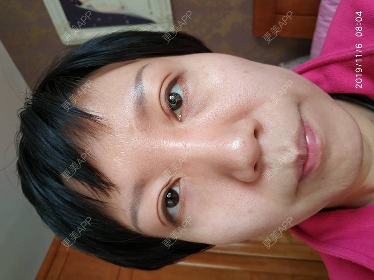 更美 - 更美用户WFzD4DOKgO的自体脂肪填充泪沟经验 | 自体脂肪填充泪沟 | 自体脂肪丰苹果肌 | 自体脂肪垫下巴 | 自体脂肪丰太阳穴 | 吸脂 | 成都