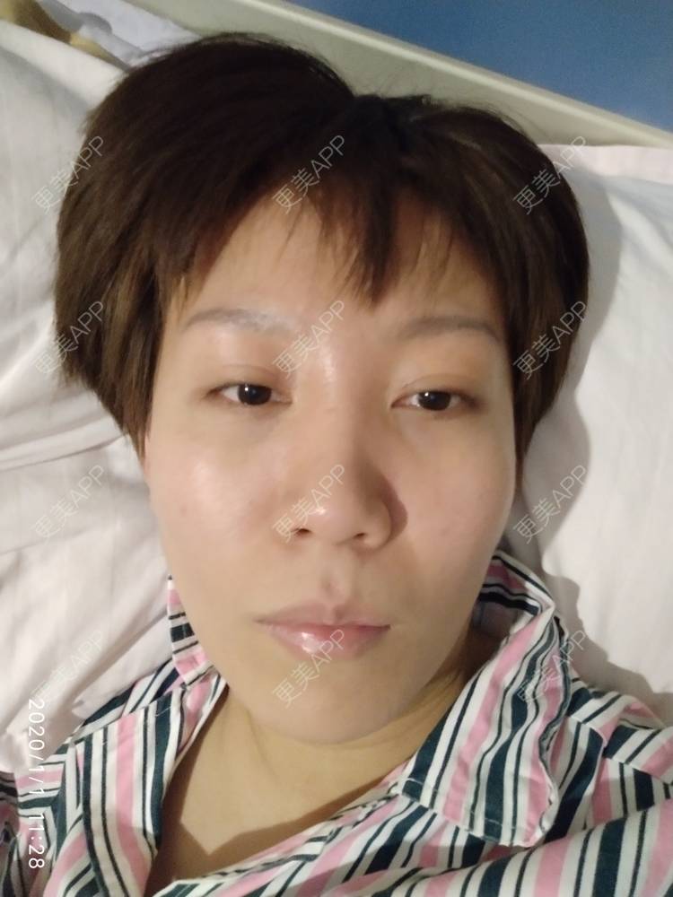 更美 - 更美用户WFzD4DOKgO的自体脂肪填充泪沟经验 | 自体脂肪填充泪沟 | 自体脂肪丰苹果肌 | 自体脂肪垫下巴 | 自体脂肪丰太阳穴 | 吸脂 | 成都