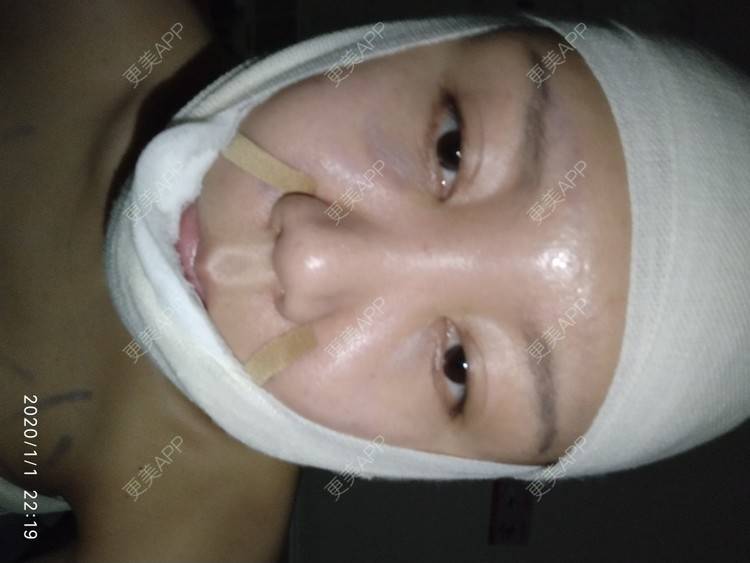 更美 - 更美用户WFzD4DOKgO的自体脂肪填充泪沟经验 | 自体脂肪填充泪沟 | 自体脂肪隆鼻 | 自体脂肪丰苹果肌 | 自体脂肪垫下巴 | 自体脂肪丰太阳穴 | 自体脂肪丰额头 | 吸脂 | 成都