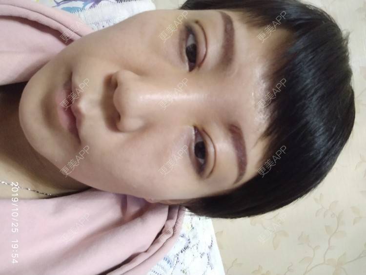 更美 - 更美用户WFzD4DOKgO的自体脂肪填充泪沟经验 | 自体脂肪填充泪沟 | 自体脂肪隆鼻 | 自体脂肪丰苹果肌 | 自体脂肪垫下巴 | 自体脂肪丰太阳穴 | 自体脂肪丰额头 | 吸脂 | 成都