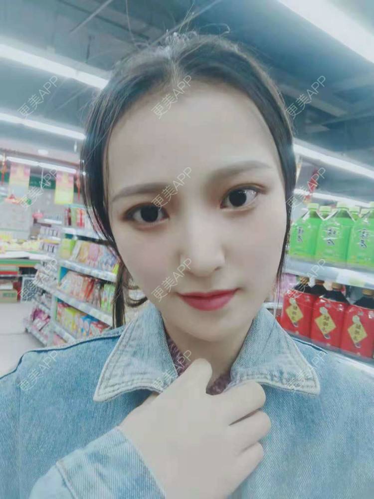 更美 - 勤晴小姐🌿的肋软骨隆鼻经验 | 肋软骨隆鼻 | 隆鼻 | 南京