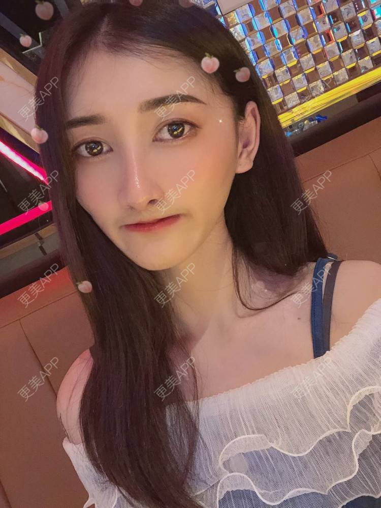 更美 - 最美的期待i的鼻形态修复经验 | 广州 | 鼻形态修复
