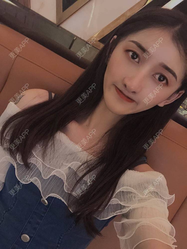 更美 - 最美的期待i的鼻形态修复经验 | 广州 | 鼻形态修复