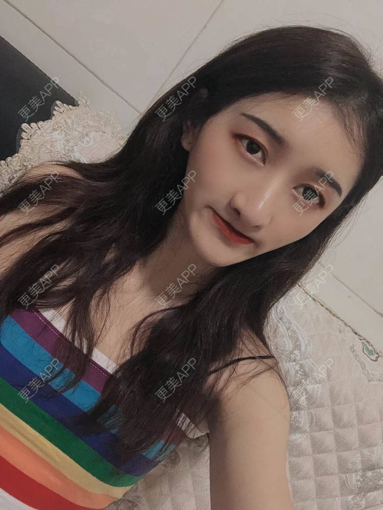 更美 - 最美的期待i的鼻形态修复经验 | 广州 | 鼻形态修复