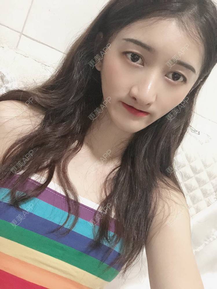 更美 - 最美的期待i的鼻形态修复经验 | 广州 | 鼻形态修复