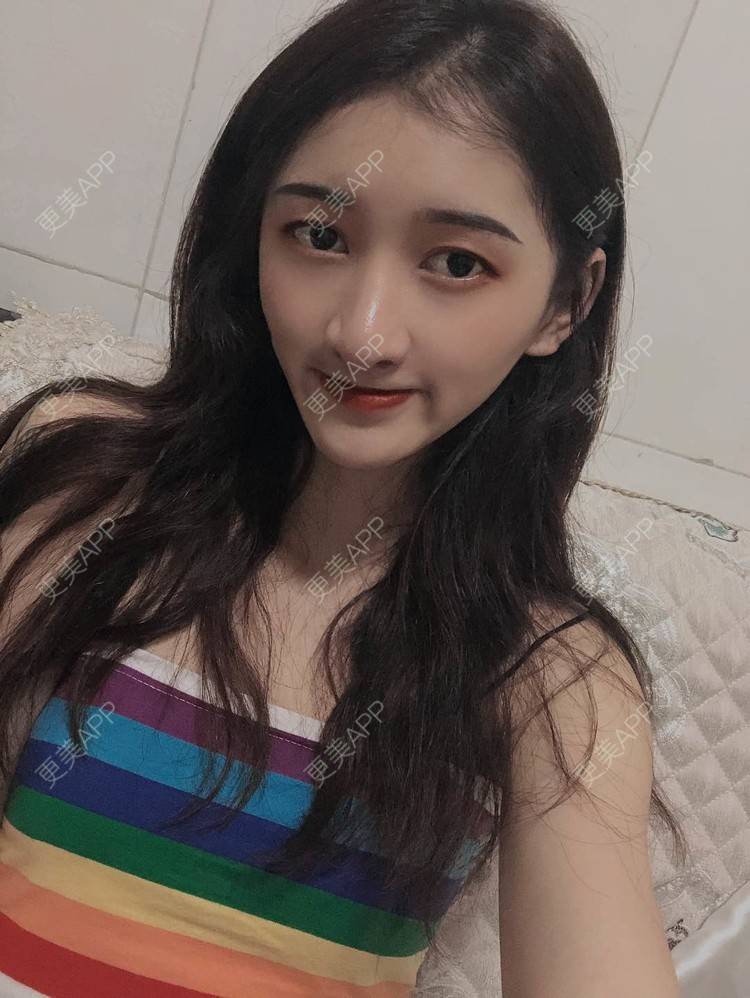 更美 - 最美的期待i的鼻形态修复经验 | 广州 | 鼻形态修复