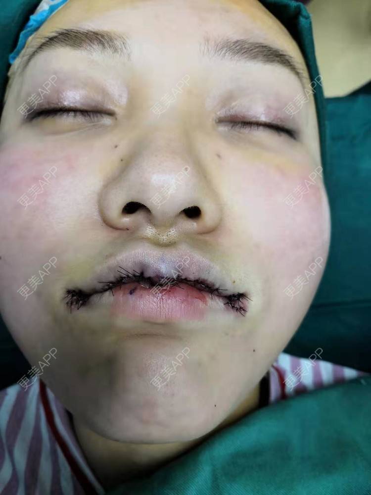 分享到:m唇成形对比图推荐商品【m唇成形】m唇成形 m唇手术上唇m唇