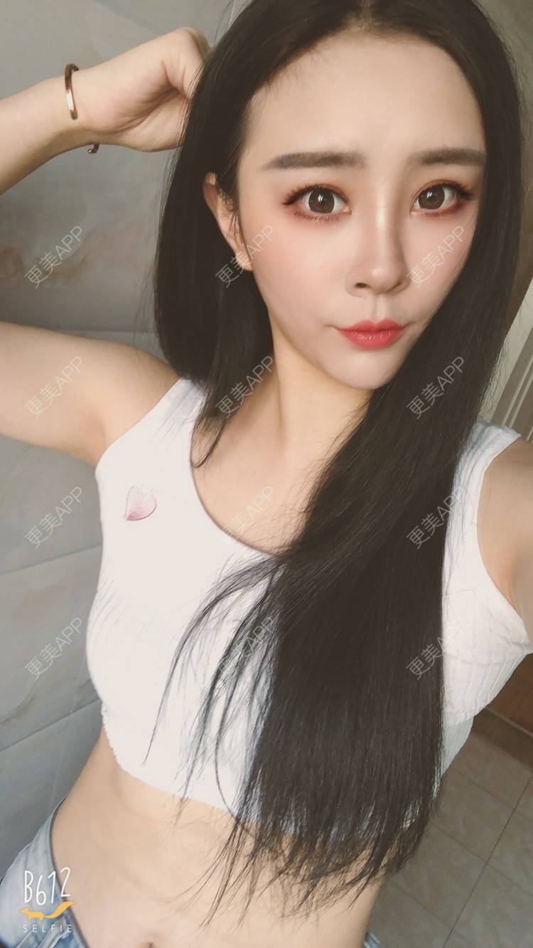 更美 - °薄凉的射频溶脂瘦手臂经验 | 杭州 | 视频日记 | 射频溶脂瘦手臂