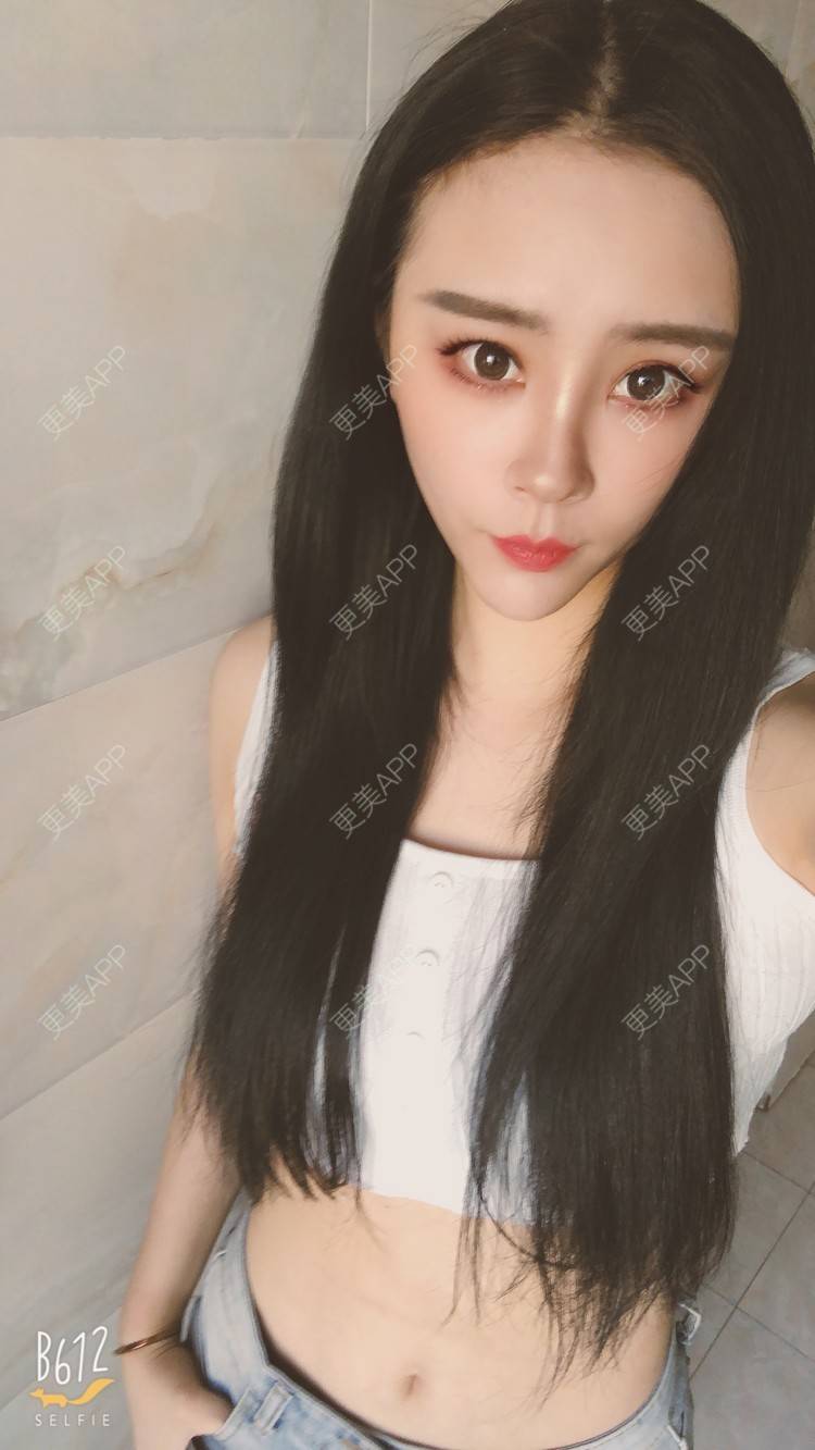 更美 - °薄凉的射频溶脂瘦手臂经验 | 杭州 | 视频日记 | 射频溶脂瘦手臂