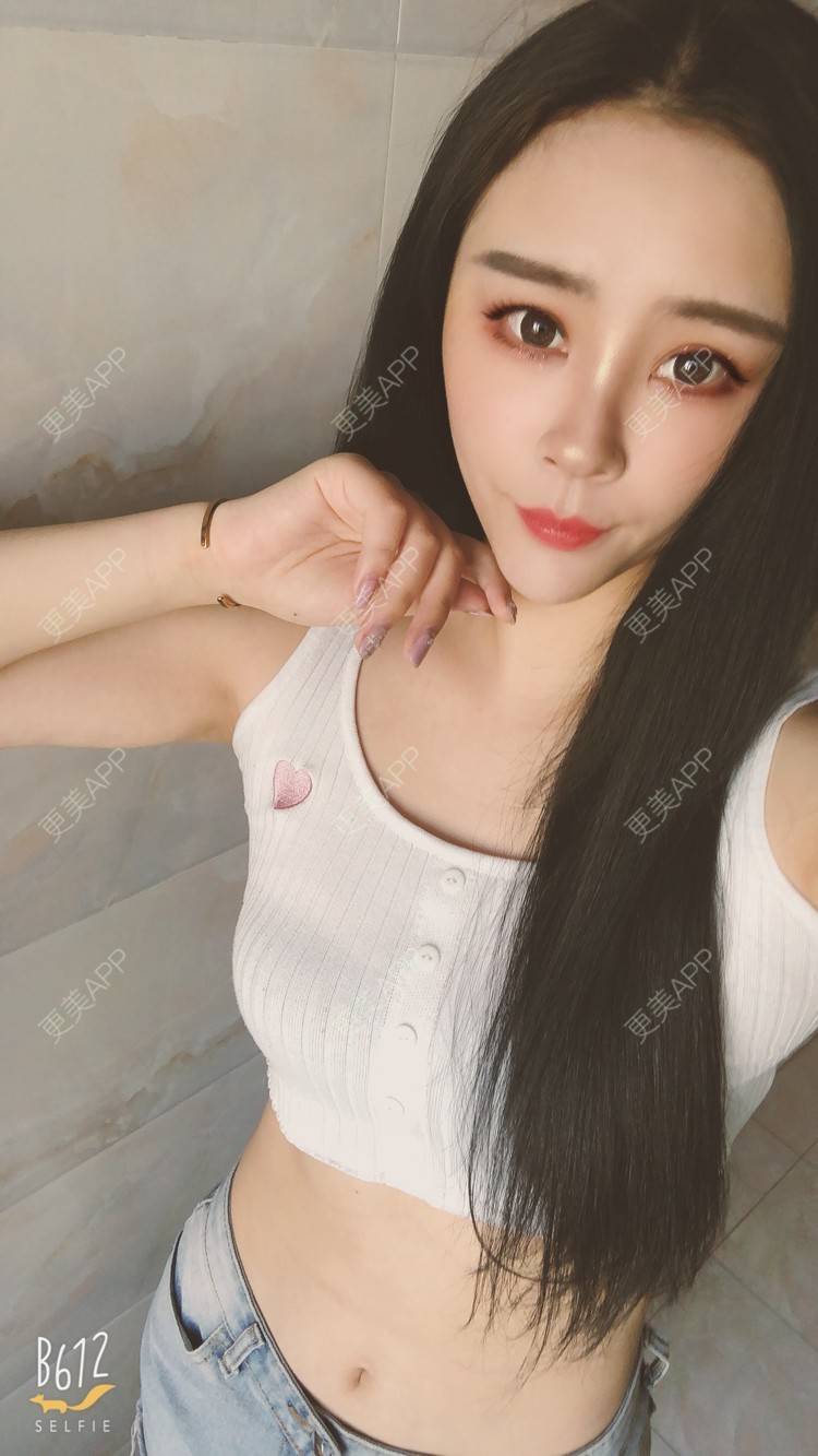 更美 - °薄凉的射频溶脂瘦手臂经验 | 杭州 | 视频日记 | 射频溶脂瘦手臂
