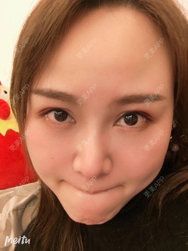 更美 - 纪薇筱的全切双眼皮经验 | 双眼皮修复 | 全切双眼皮 | 重庆 | 上眼睑去脂 | 眼部多项 | 开眼角修复