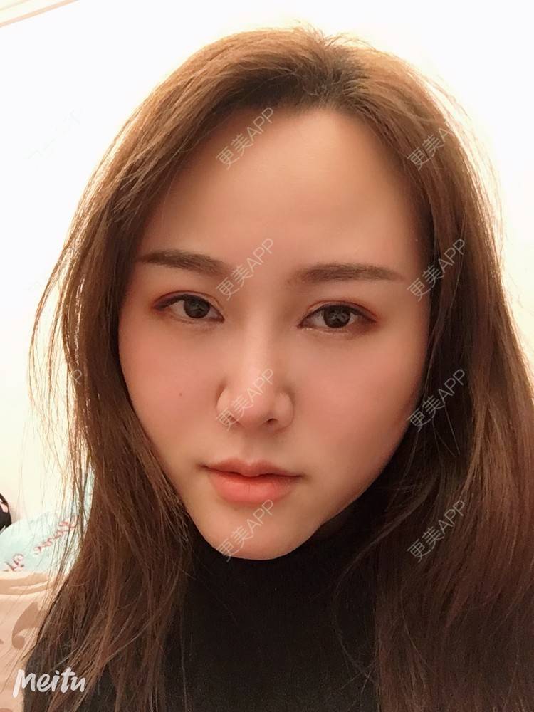 更美 - 纪薇筱的全切双眼皮经验 | 双眼皮修复 | 全切双眼皮 | 重庆 | 上眼睑去脂 | 眼部多项 | 开眼角修复