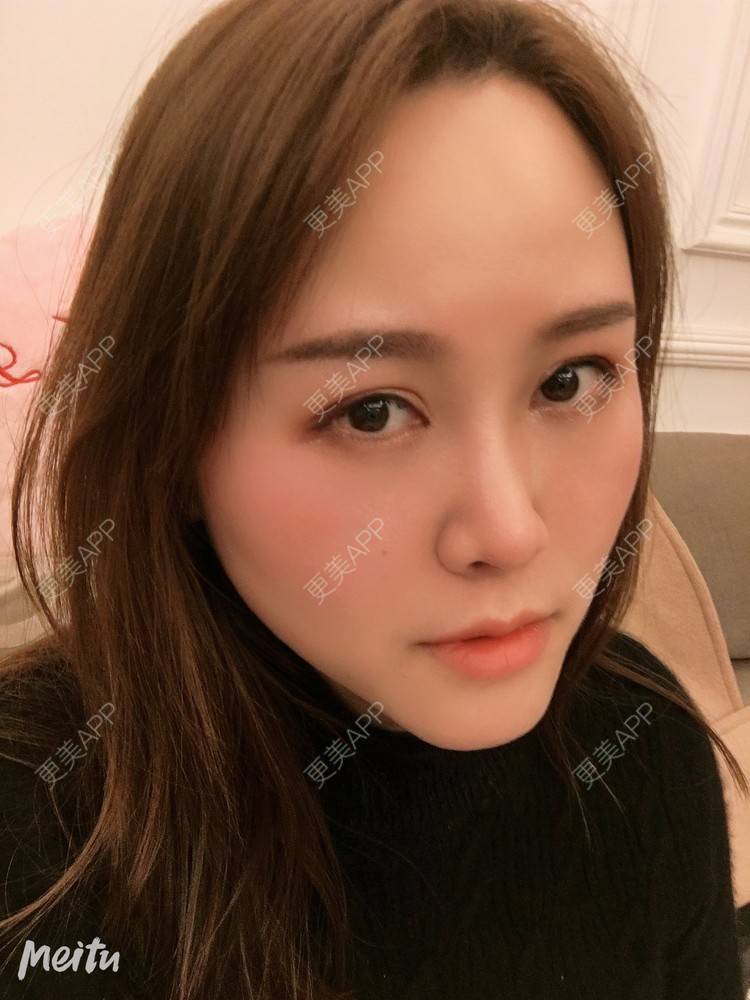 更美 - 纪薇筱的全切双眼皮经验 | 双眼皮修复 | 全切双眼皮 | 重庆 | 上眼睑去脂 | 眼部多项 | 开眼角修复