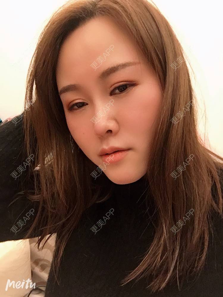 更美 - 纪薇筱的全切双眼皮经验 | 双眼皮修复 | 全切双眼皮 | 重庆 | 上眼睑去脂 | 眼部多项 | 开眼角修复