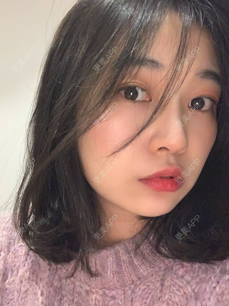 更美 - 西瓜朵朵开的鼻部多项经验 | 鼻部多项 | 自体软骨垫鼻尖 | 膨体隆鼻 | 重庆 | 鼻中隔软骨隆鼻 | 耳软骨隆鼻