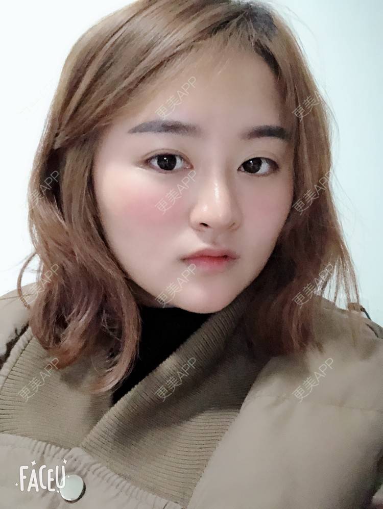 更美 - 浑身上下的肋软骨隆鼻经验 | 更美研究所 | 杭州 | 肋软骨隆鼻 | 隆鼻