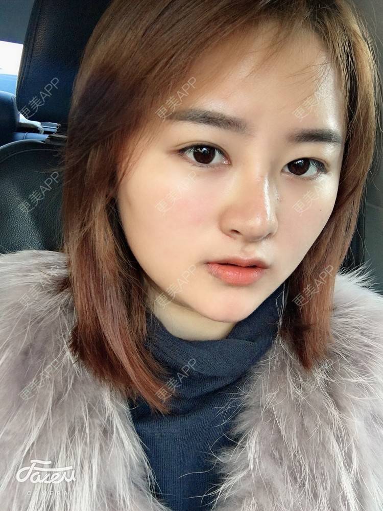 更美 - 浑身上下的肋软骨隆鼻经验 | 更美研究所 | 杭州 | 肋软骨隆鼻 | 隆鼻