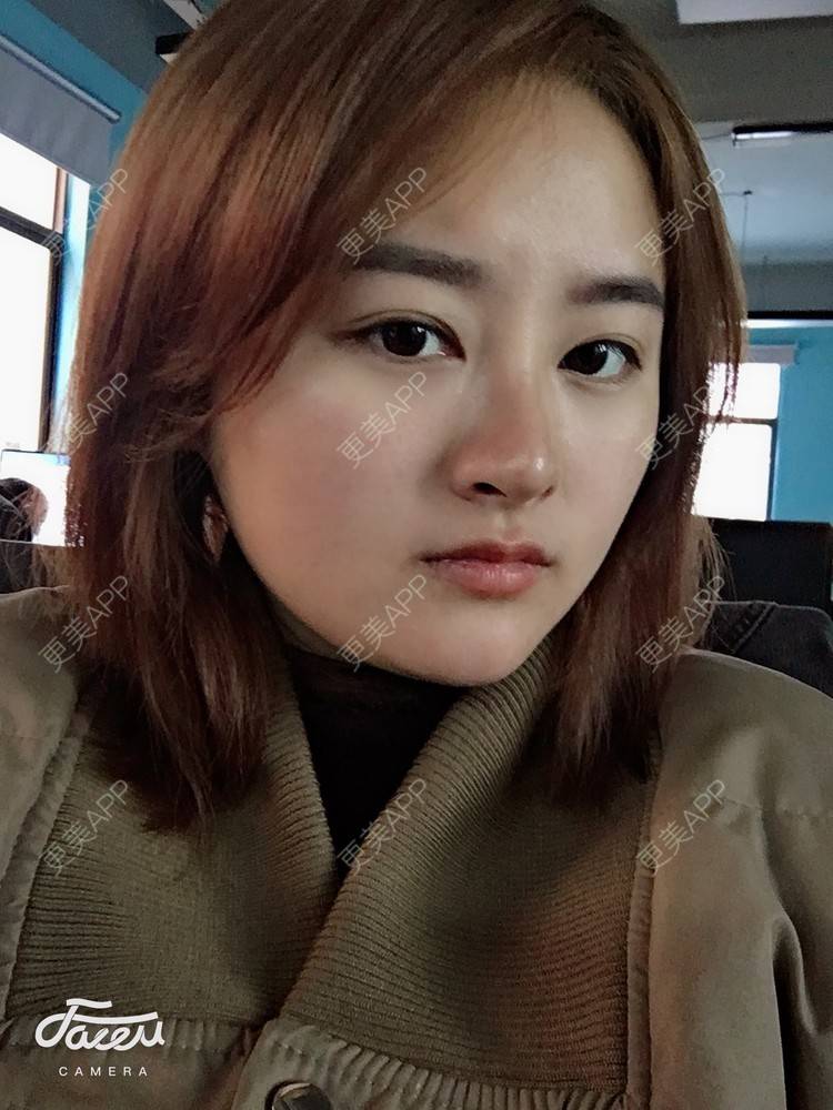 更美 - 浑身上下的肋软骨隆鼻经验 | 更美研究所 | 杭州 | 肋软骨隆鼻 | 隆鼻