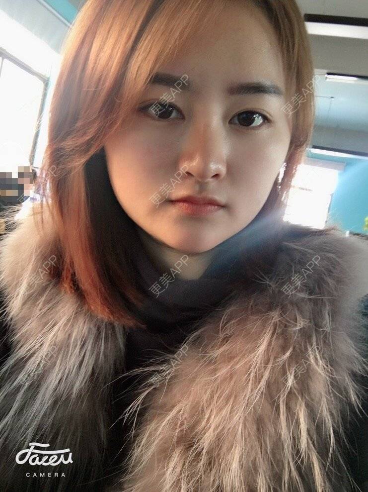 更美 - 浑身上下的肋软骨隆鼻经验 | 更美研究所 | 杭州 | 肋软骨隆鼻 | 隆鼻