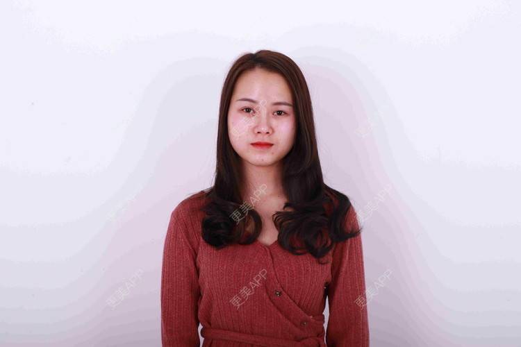 更美 - 米连菊 医生的玻尿酸鼻部经验 | 广州 | 玻尿酸鼻部