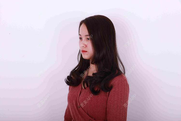 更美 - 米连菊 医生的玻尿酸鼻部经验 | 广州 | 玻尿酸鼻部
