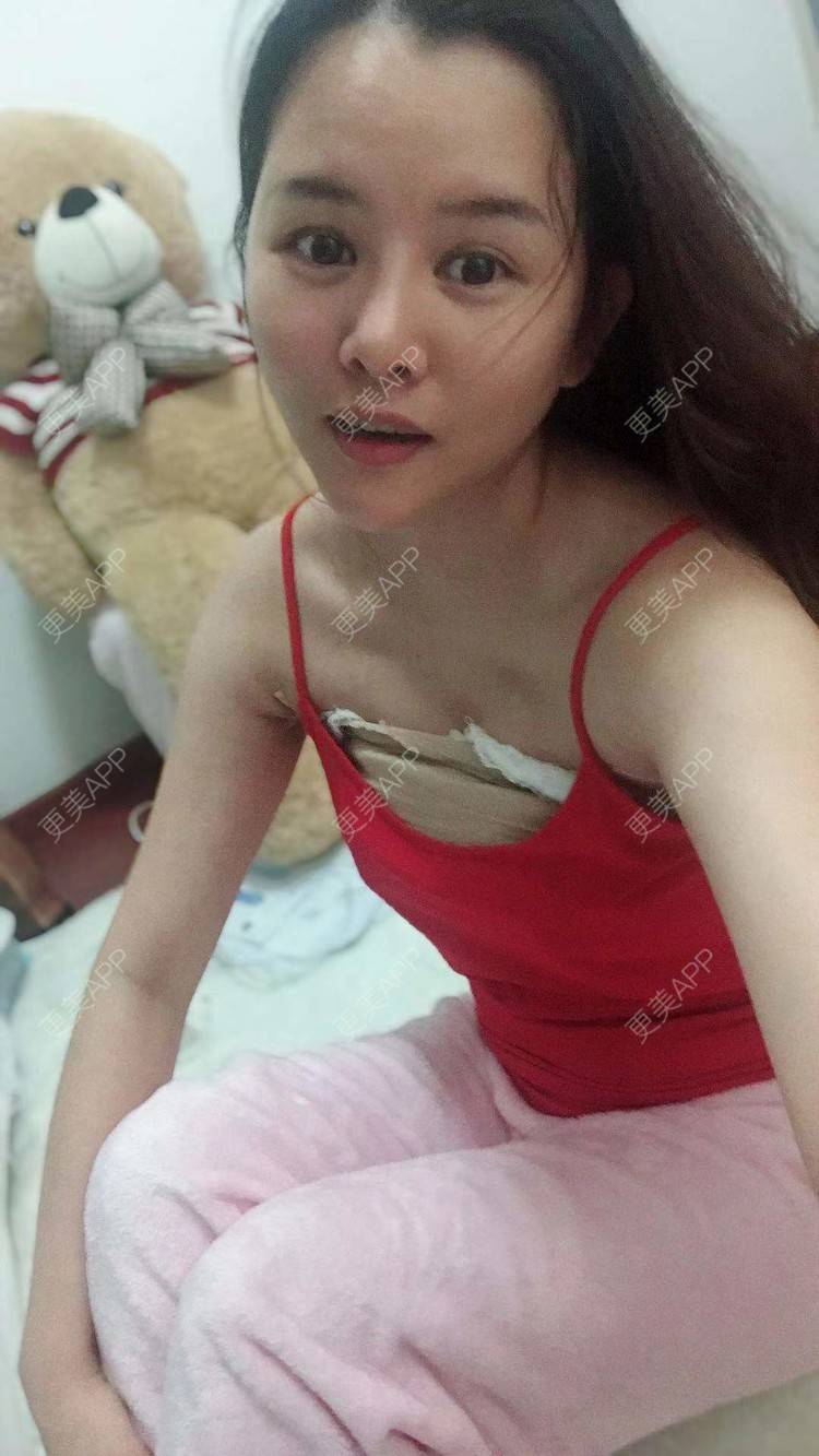 茵你而美丽的假体隆胸日记