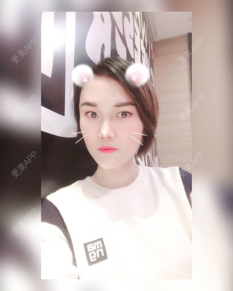 更美 - 安迪🌷的玻尿酸面颊经验 | 视频日记 | 上海 | 玻尿酸面颊