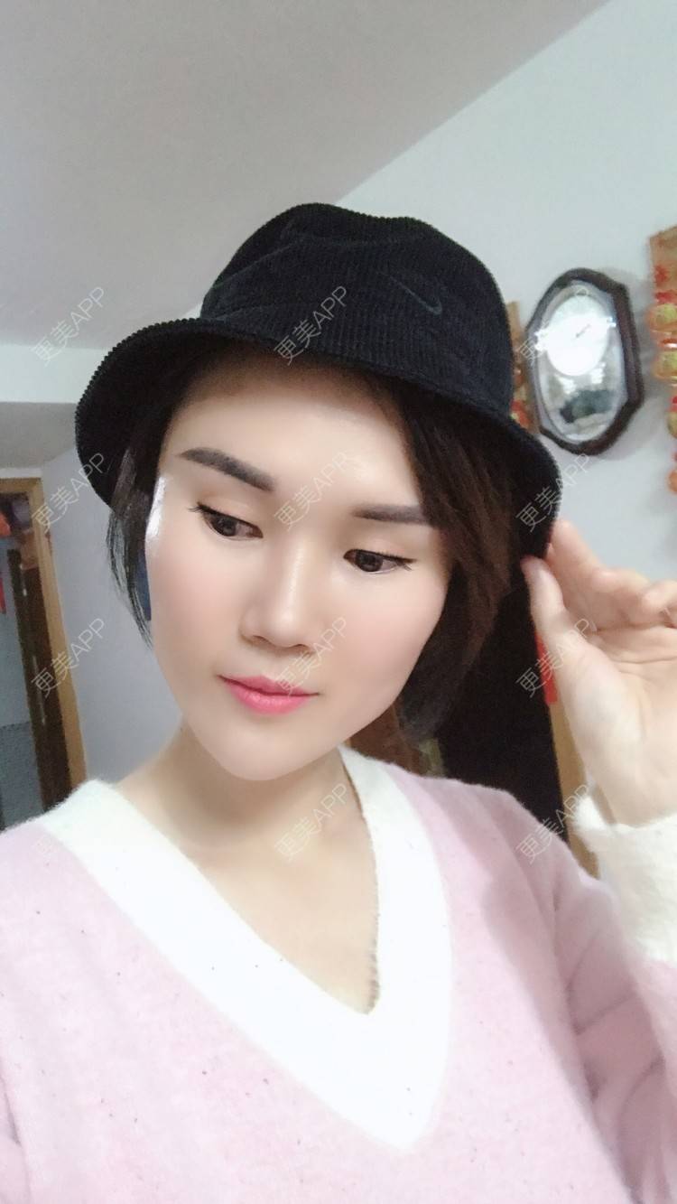 更美 - 安迪🌷的玻尿酸面颊经验 | 视频日记 | 上海 | 玻尿酸面颊