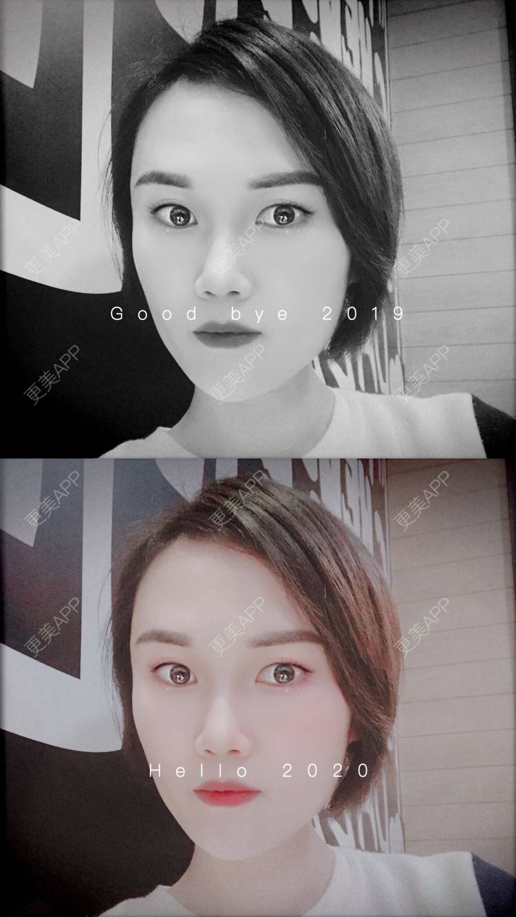 更美 - 安迪🌷的玻尿酸面颊经验 | 视频日记 | 上海 | 玻尿酸面颊