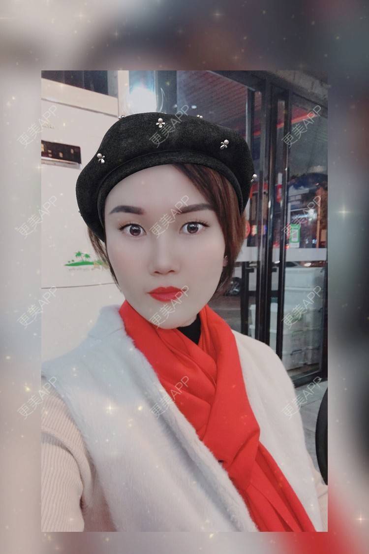 更美 - 安迪🌷的玻尿酸面颊经验 | 视频日记 | 上海 | 玻尿酸面颊