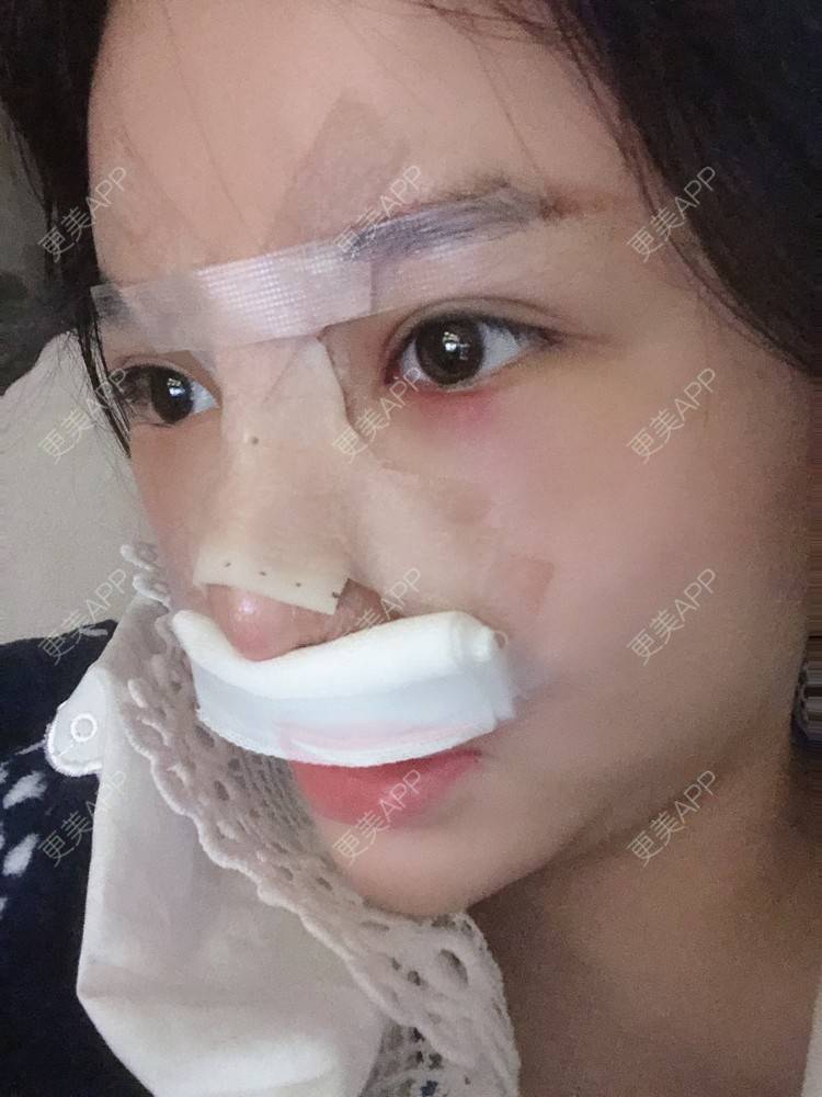 更美 - 格宝宝🍼的肋软骨隆鼻经验 | 肋软骨隆鼻 | 武汉