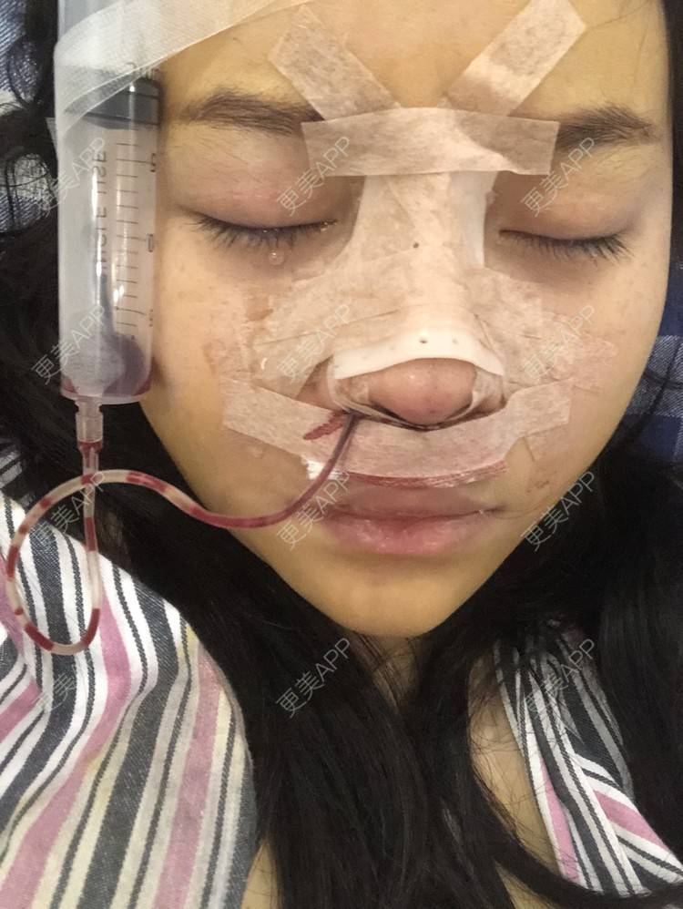 更美 - 格宝宝🍼的肋软骨隆鼻经验 | 肋软骨隆鼻 | 武汉