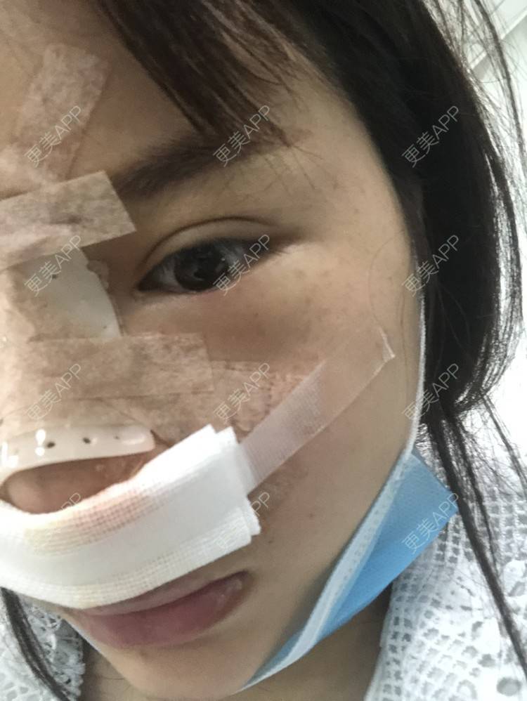 更美 - 格宝宝🍼的肋软骨隆鼻经验 | 肋软骨隆鼻 | 武汉