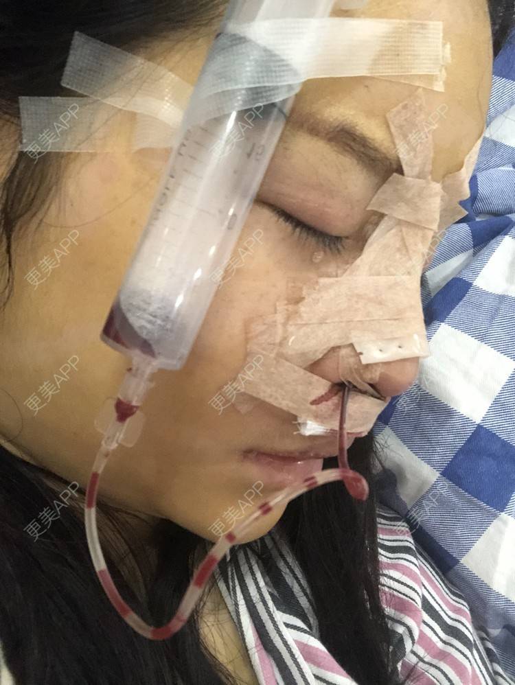 更美 - 格宝宝🍼的肋软骨隆鼻经验 | 肋软骨隆鼻 | 武汉