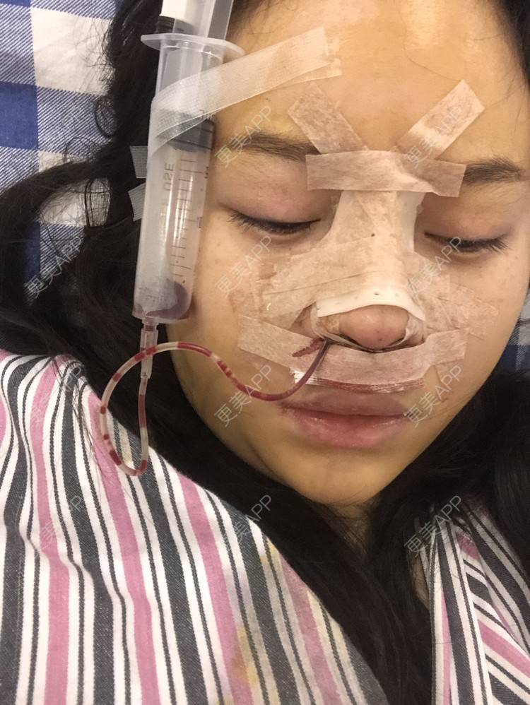 更美 - 格宝宝🍼的肋软骨隆鼻经验 | 肋软骨隆鼻 | 武汉