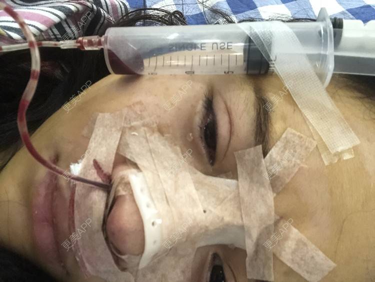 更美 - 格宝宝🍼的肋软骨隆鼻经验 | 肋软骨隆鼻 | 武汉