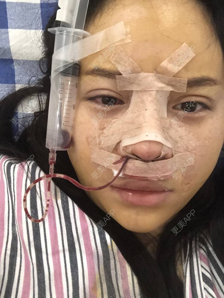 更美 - 格宝宝🍼的肋软骨隆鼻经验 | 肋软骨隆鼻 | 武汉