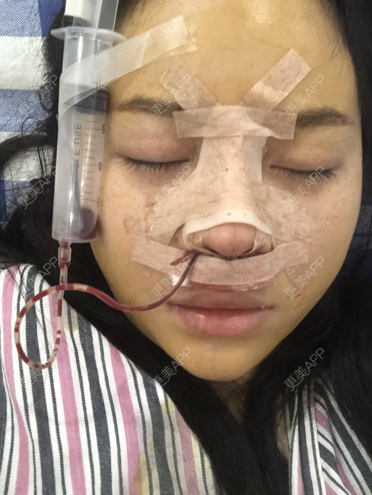 更美 - 格宝宝🍼的肋软骨隆鼻经验 | 肋软骨隆鼻 | 武汉