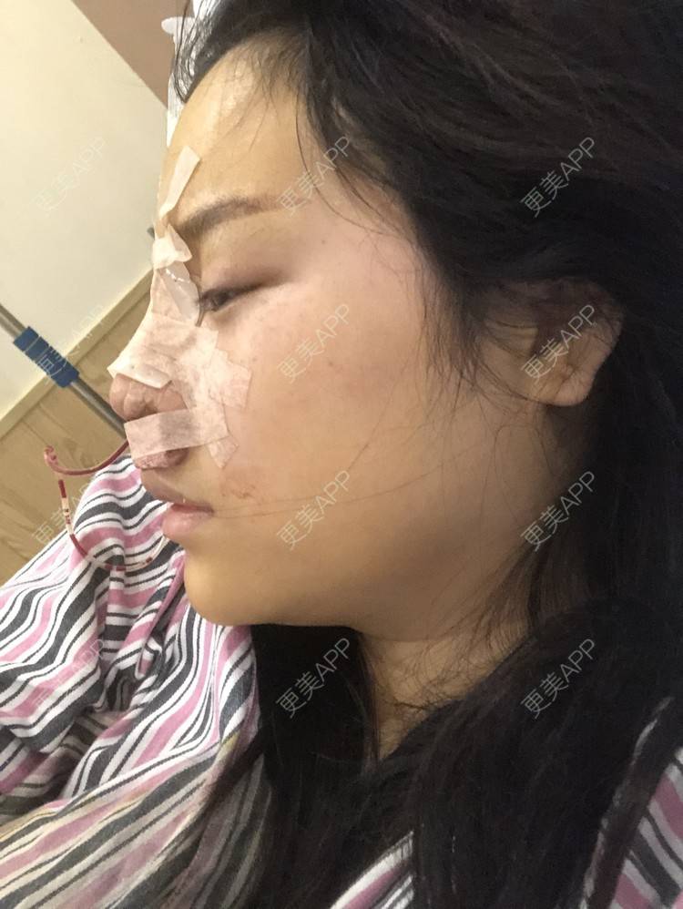 更美 - 格宝宝🍼的肋软骨隆鼻经验 | 肋软骨隆鼻 | 武汉