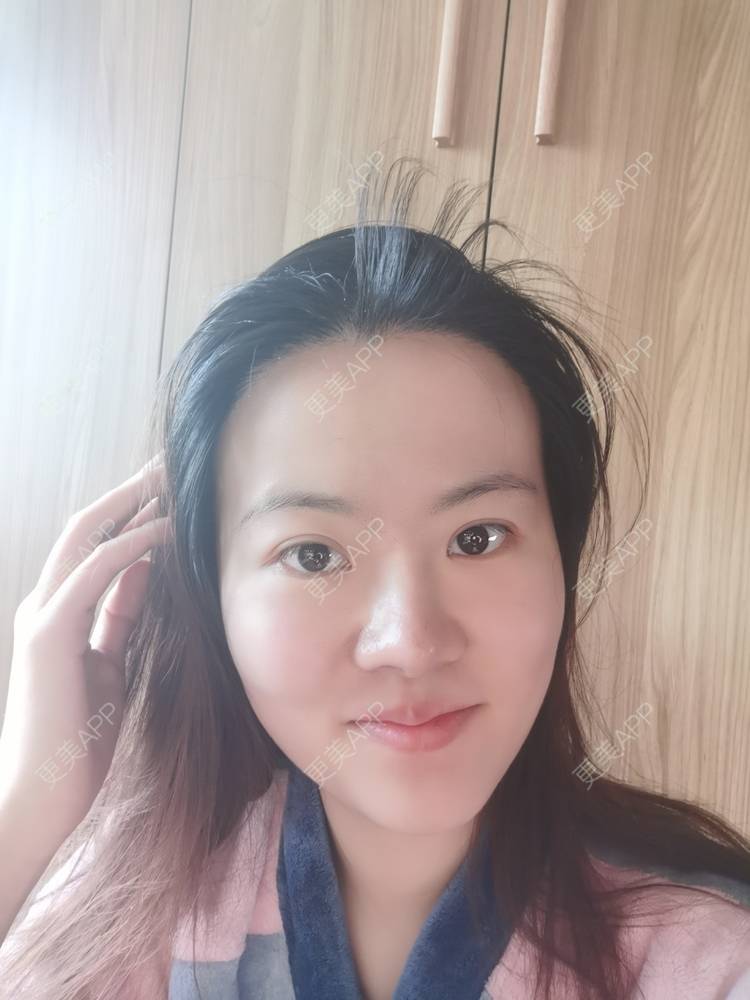 更美 - umgsd的植发际线经验 | 植发际线 | 上海